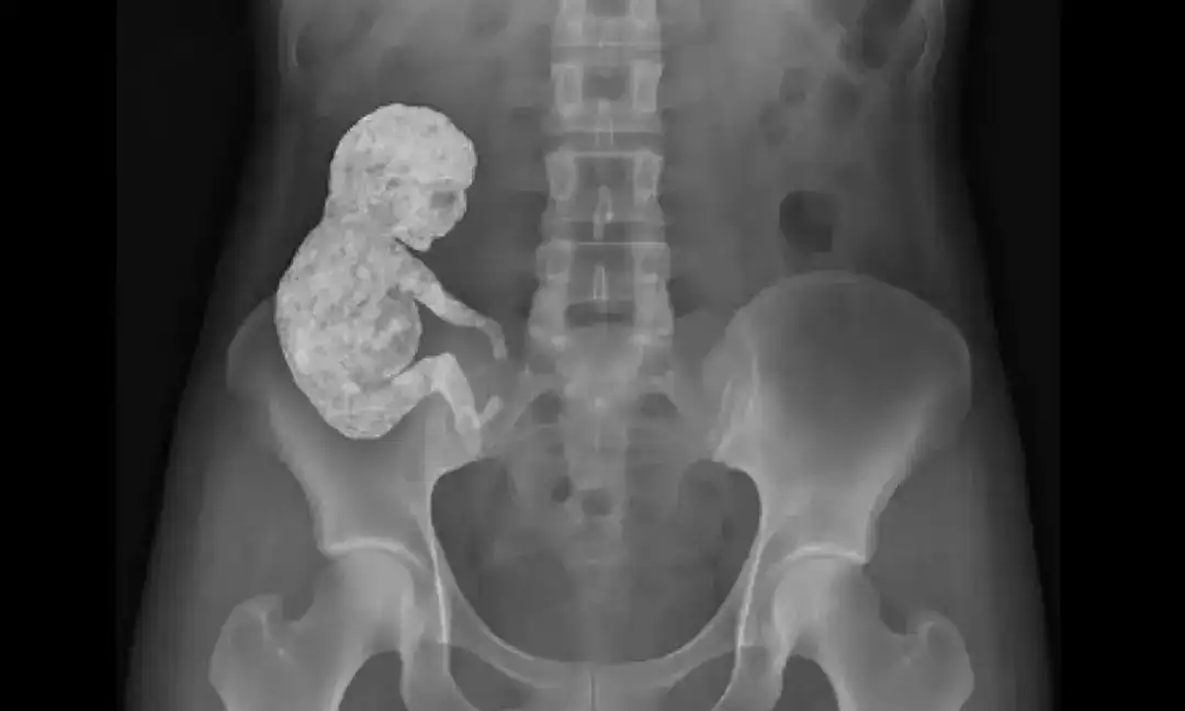 40 ఏళ్ల పాటు గర్భంలో శిశువు.. 82 ఏళ్ల వయసులో బయటపడ్డ షాకింగ్ నిజం | Stone Baby Case